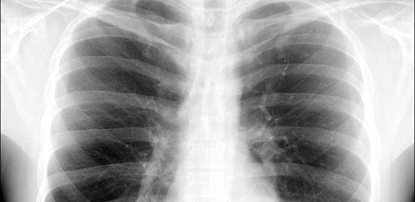X-ray photo of a chest