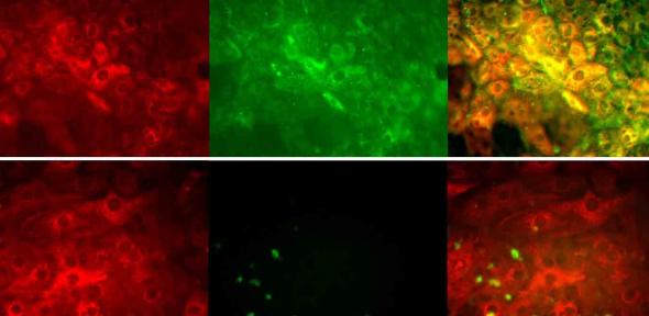 Top images diseased liver cells, bottom images healthy liver cells