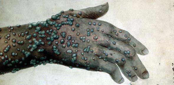Watercolour of a hand with smallpox by Robert Carswell in 1831