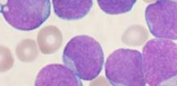 A Wright's stained bone marrow aspirate smear of patient with precursor B-cell acute lymphoblastic leukemia