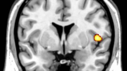 MRI brain scan highlights the insula, one of the areas of the brain that is reduced in volume in subjects with Conduct Disorder.