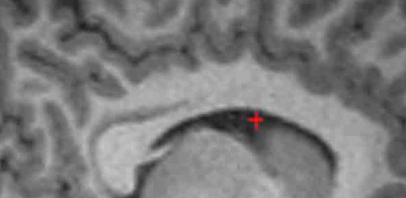 fMRI of individual without a PCS