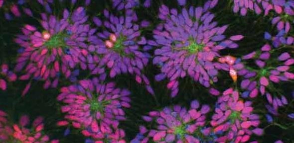 Rosettes of human, patient-specific neural stem cells