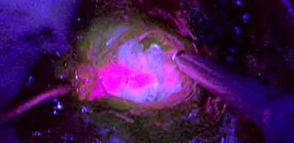 Tumour