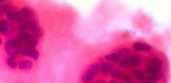 Metastatic breast cancer in pleural field.