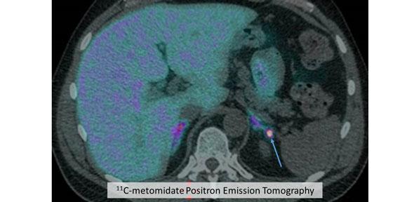 11C metomidate PET CT of small Conn's tumour