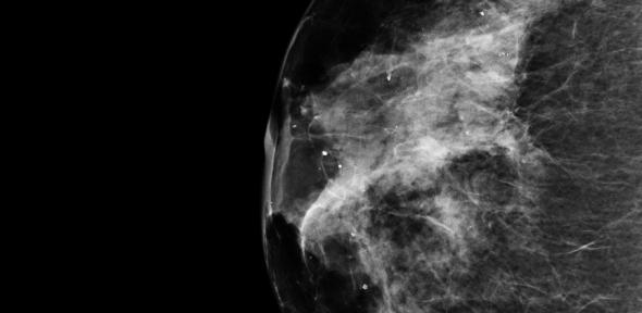 Breast cancer image