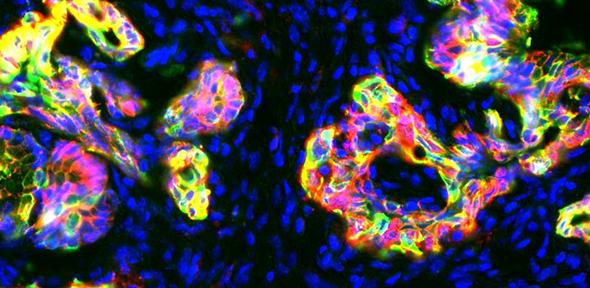 Pre-cancerous pancreatic tissue in mice