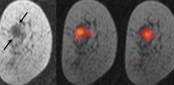 Left: Anatomic MR image of breast tumour; Right: Overlays of hyperpolarised  13C-MRI on anatomic images showing pyruvate and lactate in breast cancer
