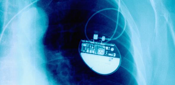 X-Ray Showing Pacemaker