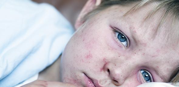 Very sick 5 year old little boy fighting measles infection, boy is laying in bed under the blanket with an agonizing expression, boy is covered with rash caused by virus.
