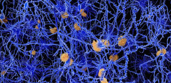 Alzheimers disease. Computer illustration of amyloid plaques amongst neurons. 