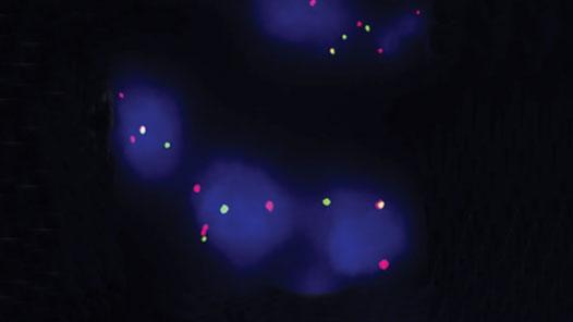 Lymphoma