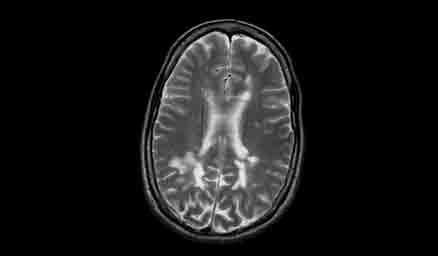 MRI showing lesions on the brain