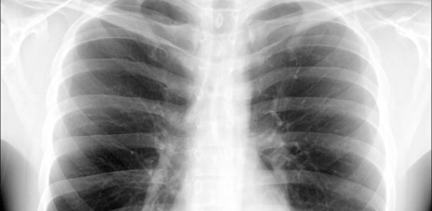 X-ray photo of a chest
