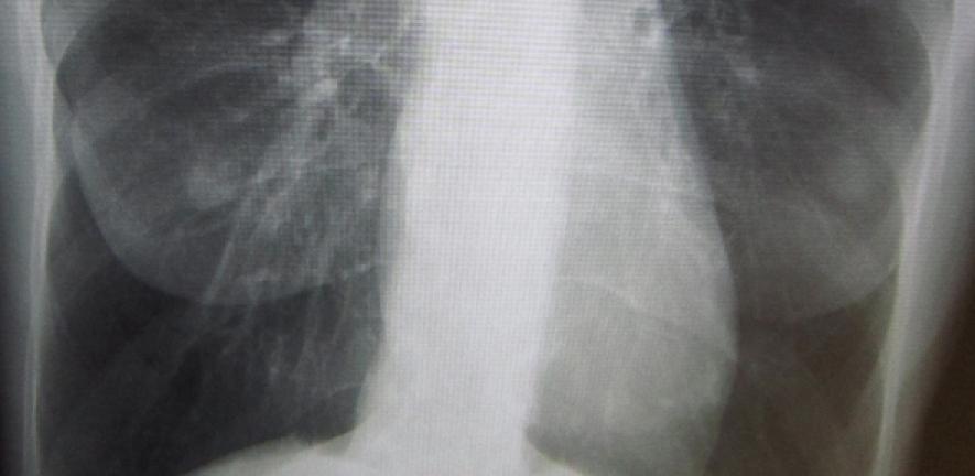 A chest X-ray demonstrating severe COPD (cropped)