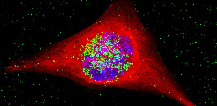 A cancer cell containing the nanoparticles. The nanoparticles are coloured green, and have entered the nucleus, which is the area in blue
