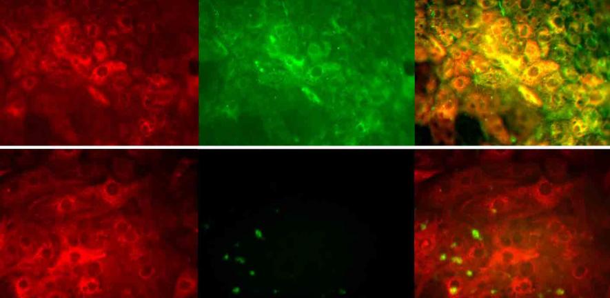 Top images diseased liver cells, bottom images healthy liver cells