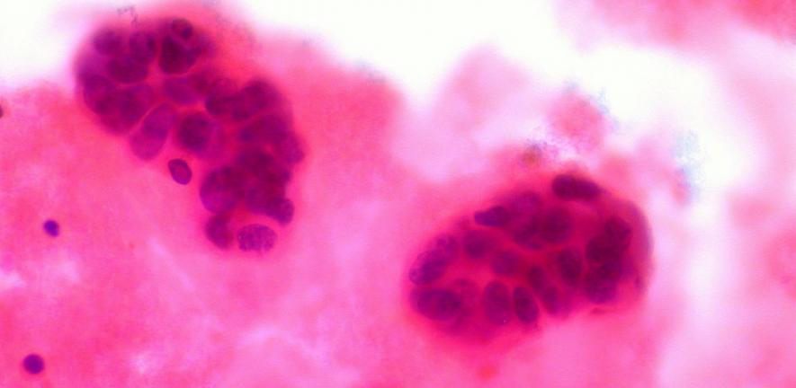 Metastatic Breast Cancer in Pleural Fluid