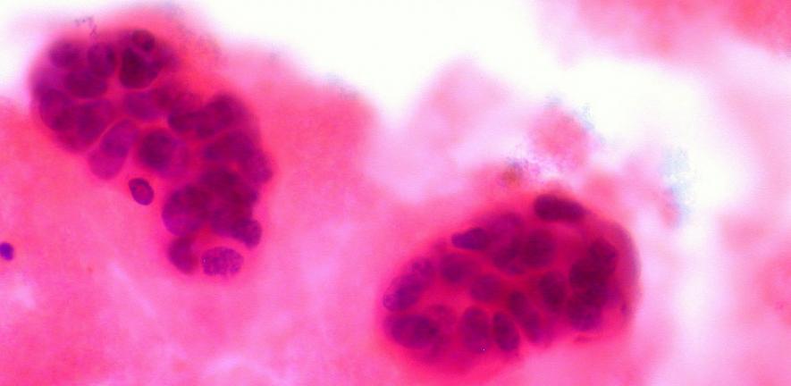Metastatic breast cancer in pleural field.