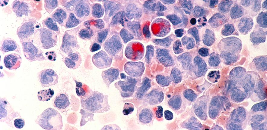 Human cells with acute myelocytic leukemia, shown with an esterase stain at 400x