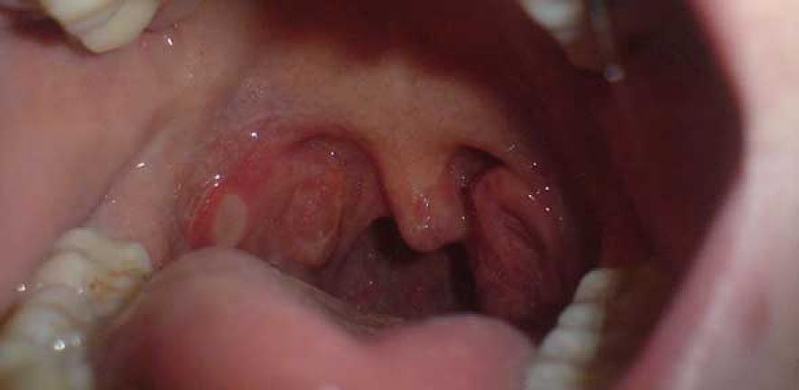 Throat ulcer