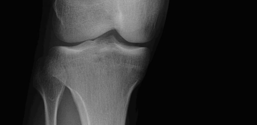 Knee With Patella Right x-ray 0003