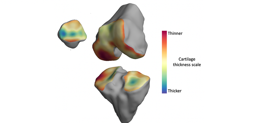 3D model of a knee with osteoarthritis