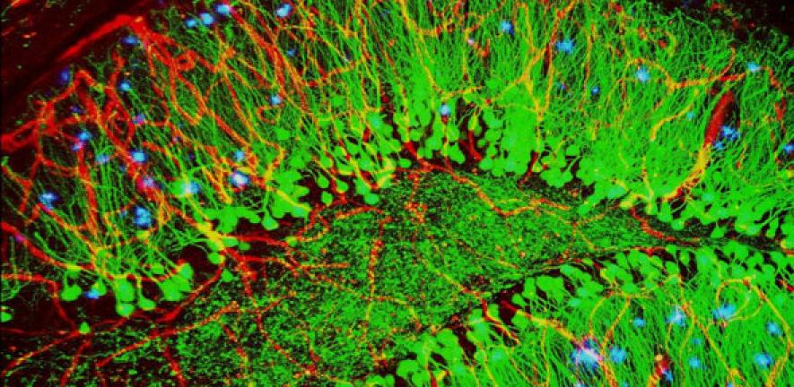 Brain showing hallmarks of Alzheimer's disease (plaques in blue)