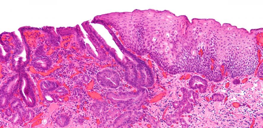 Image of an oesophageal carcinoma 
