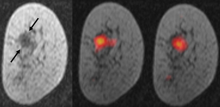 Left: Anatomic MR image of breast tumour; Right: Overlays of hyperpolarised  13C-MRI on anatomic images showing pyruvate and lactate in breast cancer