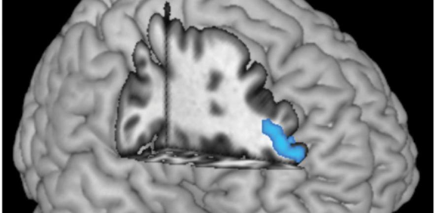 Cluster of greatest grey matter volume reduction in patients with ADHD compared with control subjects located in the left middle frontal gyrus, overlaid on a rendered standardized brain template.