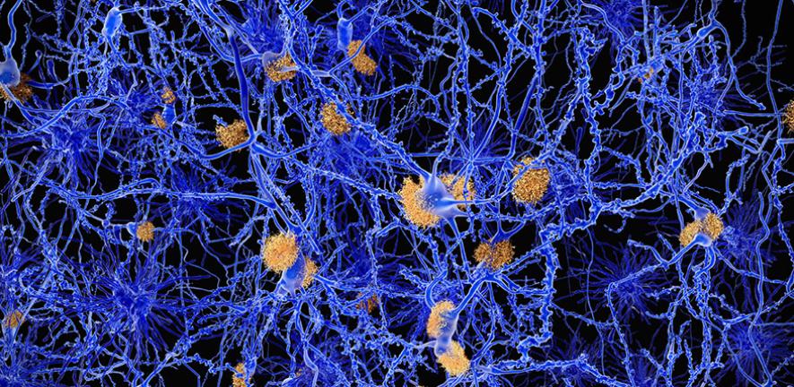 Alzheimers disease. Computer illustration of amyloid plaques amongst neurons. 