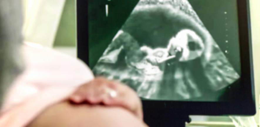 Pregnancy scan