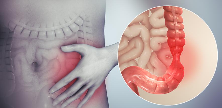 3D image showing irritable bowel syndrome