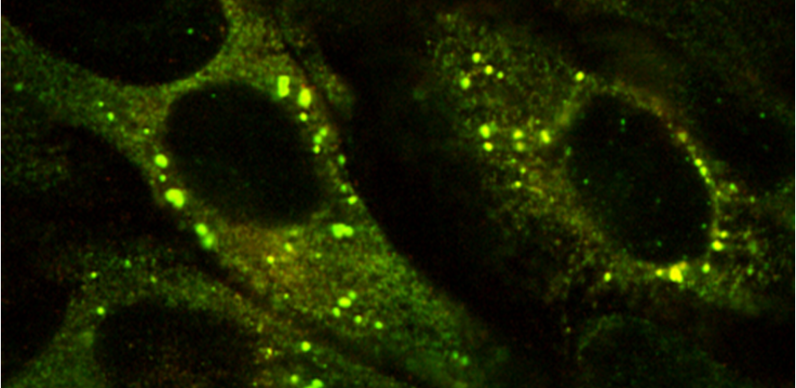 Confocal microscopy showing mutant A1AT as green inclusions within a cell