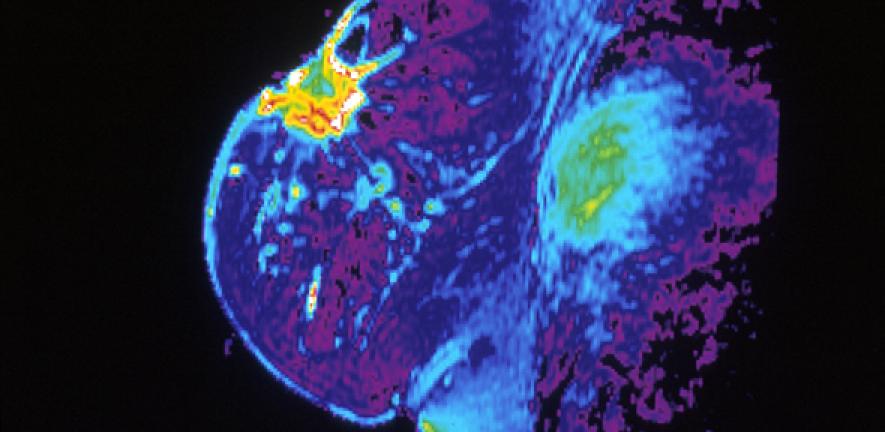 Color-enhancement show magnetic resonance image (MRI) of individual breast