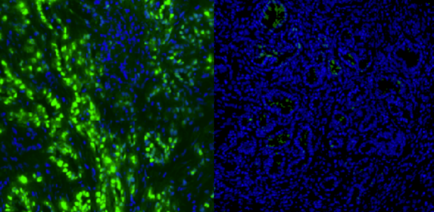 Left: pancreatic cancer cells (in green) Right: after six days of combined tumour immunotherapy, the cancerous cells had been killed.