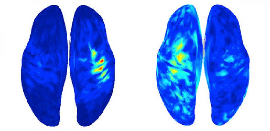 Measurement of brain activity in a patient with phantom limb pain