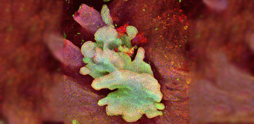 Basal cell carcinoma in mouse tail epidermis derived from a single mutant stem cell