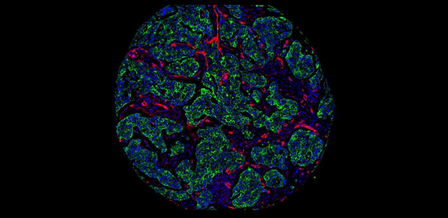 Molecular map of a breast tumour