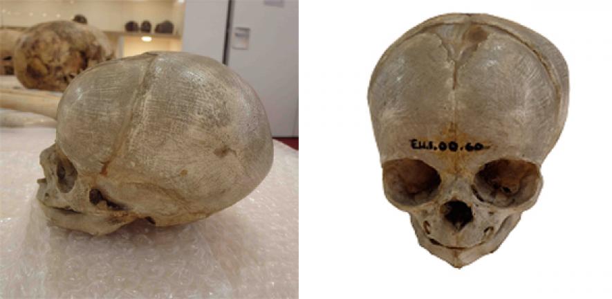 Dissected foetal skull dating from the 1800s, originally held in the University of Cambridge Anatomy Museum