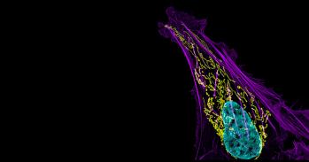 Bone cancer cell (nucleus in light blue)