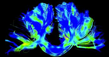 Corpus callosum, left-right connections, in a Parkinson's brain