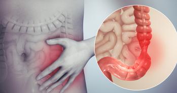 3D image showing irritable bowel syndrome