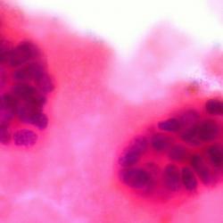Metastatic Breast Cancer in Pleural Fluid