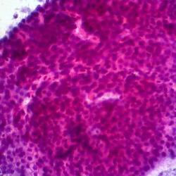  Adenocarcinoma of Pancreas, FNA 