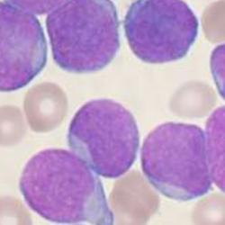 A Wright's stained bone marrow aspirate smear of patient with precursor B-cell acute lymphoblastic leukemia