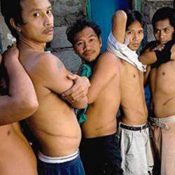 Men display their scars after kidney removal
