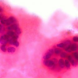 metastatic breast cancer in pleural fluid